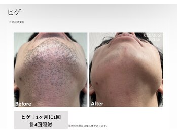 リネ(Rine)/before→after