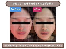 スプリング鍼灸院(Spring鍼灸院)の雰囲気（当院の美容鍼,美容鍼灸は、お身体のコリにもアプローチます♪）