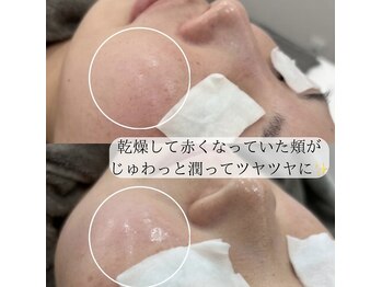 ミュー 多治見店(mieux)/◆肌質改善例