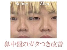 ラプリシュシュ 岡山店(Raplit)/ 隆鼻＋輪郭矯正40分10回