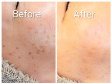 クラリス(Clarice)/シミとイボの混合..どうしたら？