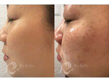 エルビービュティーサロン(LB BEAUTY SALON)/【ニキビ改善】ハーブピーリング