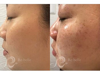 エルビービュティーサロン(LB BEAUTY SALON)/【ニキビ改善】ハーブピーリング