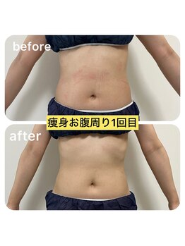 ルクール(Le Couer)/４０代痩身１回の効果