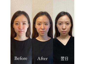 ハリカ 恵比寿 代官山店(HARIKA)/美容鍼の翌日の変化がすごい!