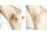 脇脱毛◎Sパーツ脱毛【脇/口周り/顎周り/頬/額/手/前首/膝/乳輪周り/O/足指】
