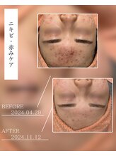 ベストベル(BestBelle)/ニキビケアはお任せください♪