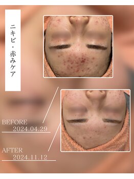 ベストベル(BestBelle)/ニキビケアはお任せください♪