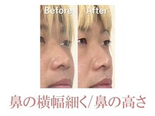 ラプリシュシュ 岡山店(Raplit)/ 隆鼻＋輪郭矯正40分10回