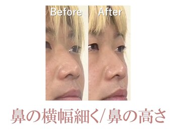 ラプリシュシュ 岡山店(Raplit)/ 隆鼻+輪郭矯正40分10回