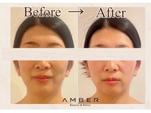 アンバー 恵比寿(AMBER)/ハーブピーリング+肌改善マシン