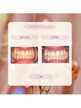 プラスビー 3号店(+b)/ホワイトニングビフォーアフター