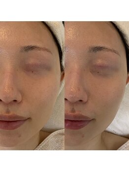 ブリス(Bliss)/リアボーテハーブトリートメント