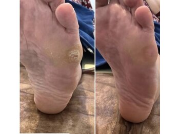 リゼラアンドコー 宇都宮店/ウオノメ、Before＆After！