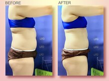 ジュリア オージェ 難波店/ビフォーアフター（脂肪燃焼)
