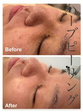 アモリール(Amolir)/ハーブピーリング　