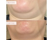 アンドニューリー(&NEWLY)/水玉リフティング　Before After