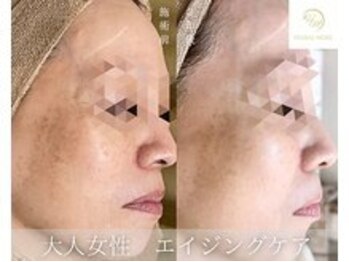 ベルフィーヌ 目黒店(BELFINE)/ハーブピーリング