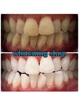 ホワイトニングショップ 大阪玉造店/Before&After美白ホワイトニング