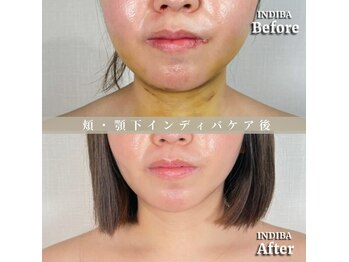 術後の女神 大阪本町店/ダウンタイムケア・インディバ