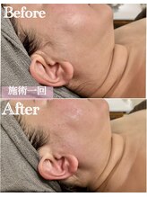 ジャミーラ(JAMIL)/◇脂肪燃焼フェイス　ビフォアフ