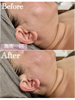 ジャミーラ(JAMIL)/◇脂肪燃焼フェイス ビフォアフ