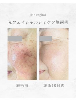 エステサロン JJシャンハイ/光フェイシャル　シミケア