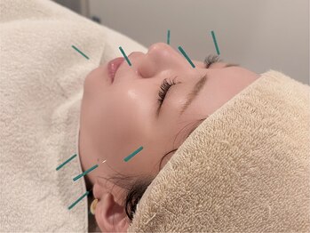 アカシア鍼灸整骨院の写真/季節の変わり目の肌トラブルには【美容鍼灸】血流改善・ターンオーバー促進！肌質改善ができる根本改善美容