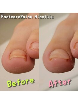 ニコルル 富田林店(Nicolulu)の写真/巻き爪のお悩みをサポート！アロマオイル保湿付きフットケア　新規　￥12800→￥10000