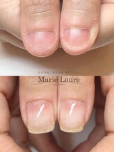 マリーロール 梅田店(Marie Laure)/自爪育成/深爪矯正/ネイルケア