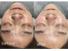 人気No.1★【小顔×目指せノーファンデ美肌】無針水光注入＋全顔毛穴洗浄
