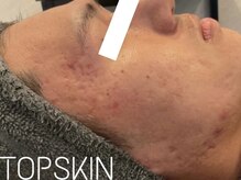 トップスキン 名駅(TOPSKIN)/長年の深いお肌悩みも根本改善！