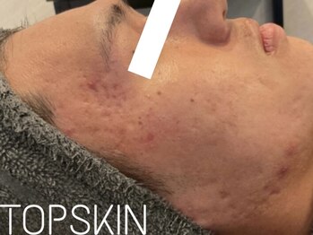 トップスキン 名駅(TOPSKIN)/長年の深いお肌悩みも根本改善!