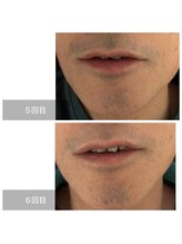 ダンニヒル(dannihil)/【ヒゲ脱毛】50代会社員6回目