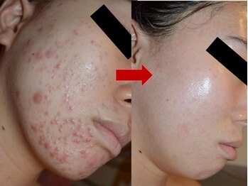 ブリリアン デイスパ 阪急西宮ガーデンズ店(BRILLIAN DAYSPA)/水光ピーリング