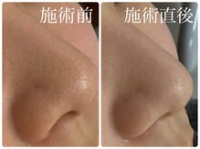 シェミー(CHEZ MEE)/毛穴洗浄で透明感も取り戻せます