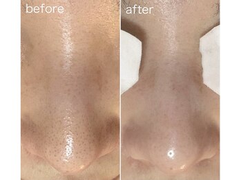 毛穴塾/即日効果実感◎毛穴撲滅(鼻のみ)