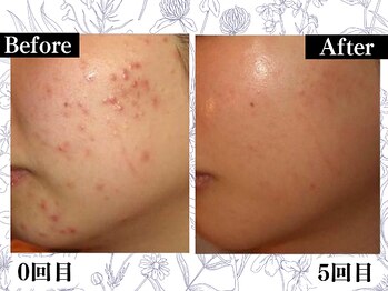 ポーベルポー(Peau Belle poe)/無添加国産ハーブピーリング