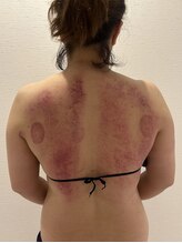 ミッシュ(Mish)/ラジオ波施術後