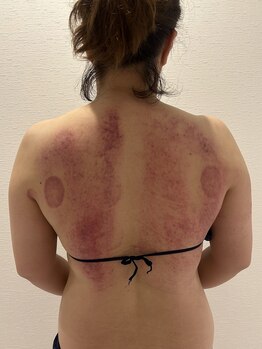 ミッシュ(Mish)/ラジオ波施術後