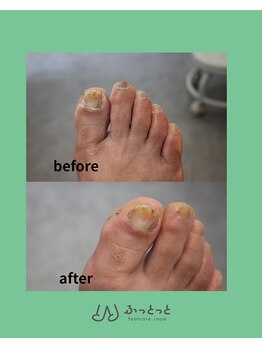 ふっとっと/爪・角質ケア before after