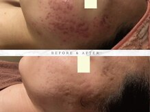 ナスサロの雰囲気（【高濃度ニキビケア ¥8,500】医療提携×看護師施術で肌荒れケア）