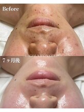 ゴールド 栄店(GOLD)/毛穴洗浄＋肌質改善効果◎
