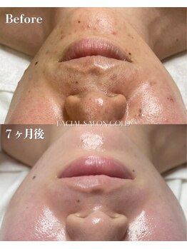 ゴールド 栄店(GOLD)/毛穴洗浄+肌質改善効果◎