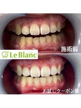 ルブラン 奈良店(Le Blanc)/2回照射