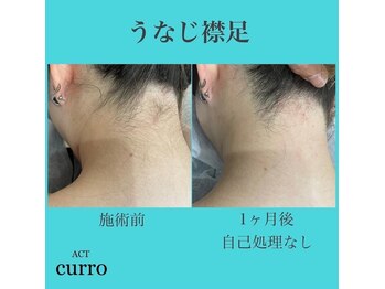 アクト クロ(ACT curro)/【うなじ襟足】脱毛施術例