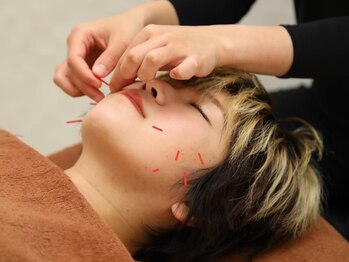 ひまわり整骨院 スポーツ(ひまわり整骨院+SPORTS)の写真/【口コミでも好評◎】疲れや血流・リンパの滞りでもなってしまうむくみやたるみケアを「美容鍼」で改善☆