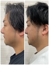 長寿鍼灸院 長寿整骨院/men's美容鍼50本効果★