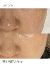 リュクス &nbsp;Luxe＋tkm 南船場/セラピールビフォーアフター