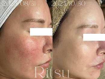 リツ(Ritsu)/赤み/敏感/火照り